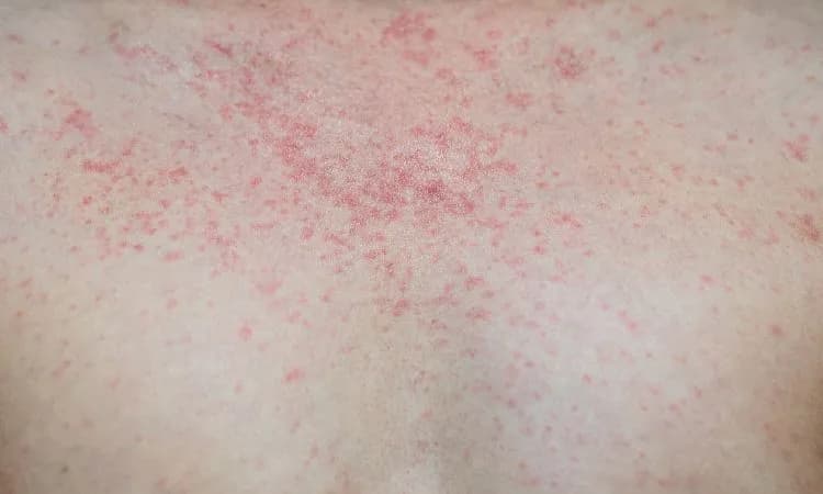 Rumień nagły u dorosłych objawy - jak je rozpoznać i leczyć