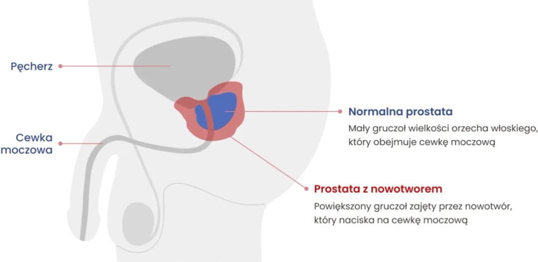 Choroba prostaty objawy - jak je rozpoznać i uniknąć powikłań