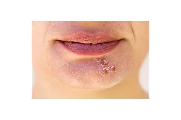 Skuteczne leki na opryszczkę bez recepty – ulga w objawach i leczeniu