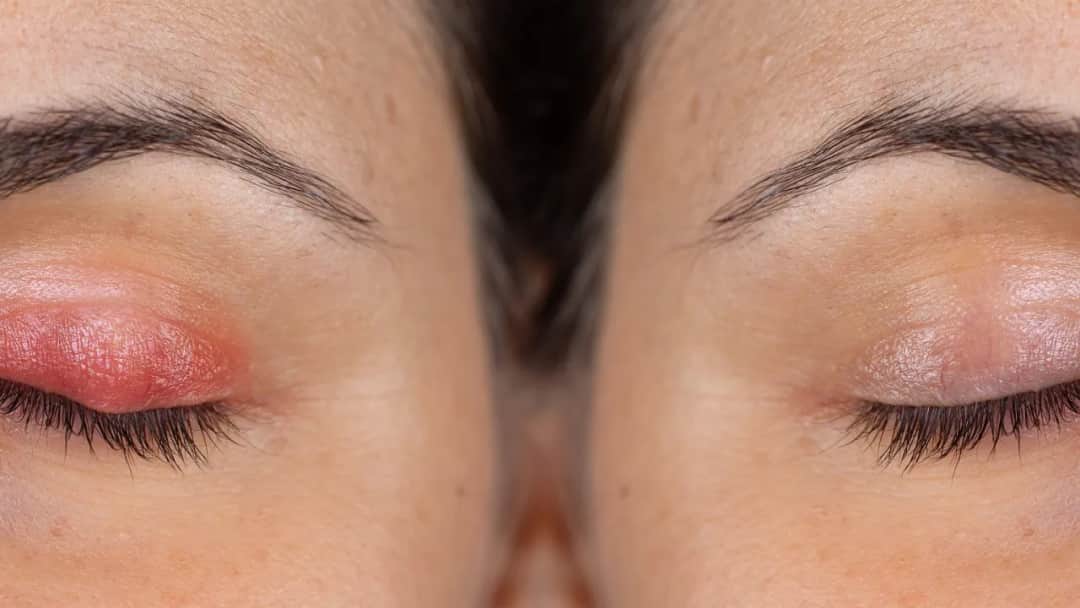 Choroby powiek: objawy i zdjęcia, które pomogą w identyfikacji