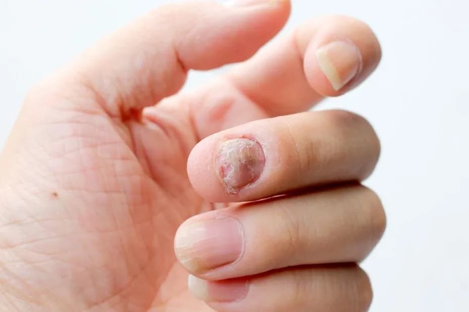 Jakie leki na grzybicę skutecznie pomogą w walce z infekcją?