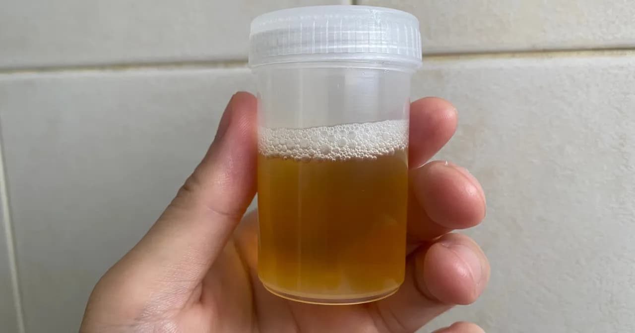 Ile moczu do badania? Oto, co musisz wiedzieć o próbkach