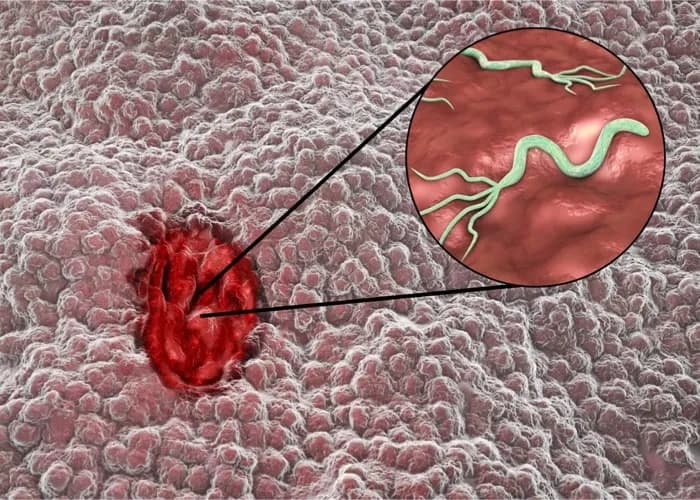 Wrzody jelitowe objawy: Jak rozpoznać i uniknąć poważnych problemów